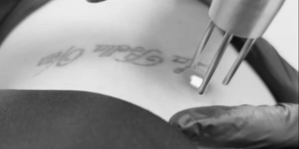 Close-up of a laser tattoo removal procedure on a person's skin.