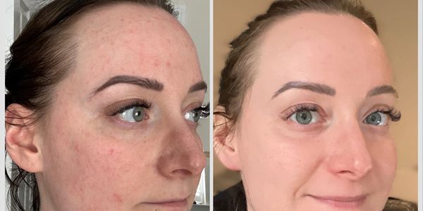 Image of Laura Knott, founder of Millbrook Aesthetics, showing the before and after pictures of skin