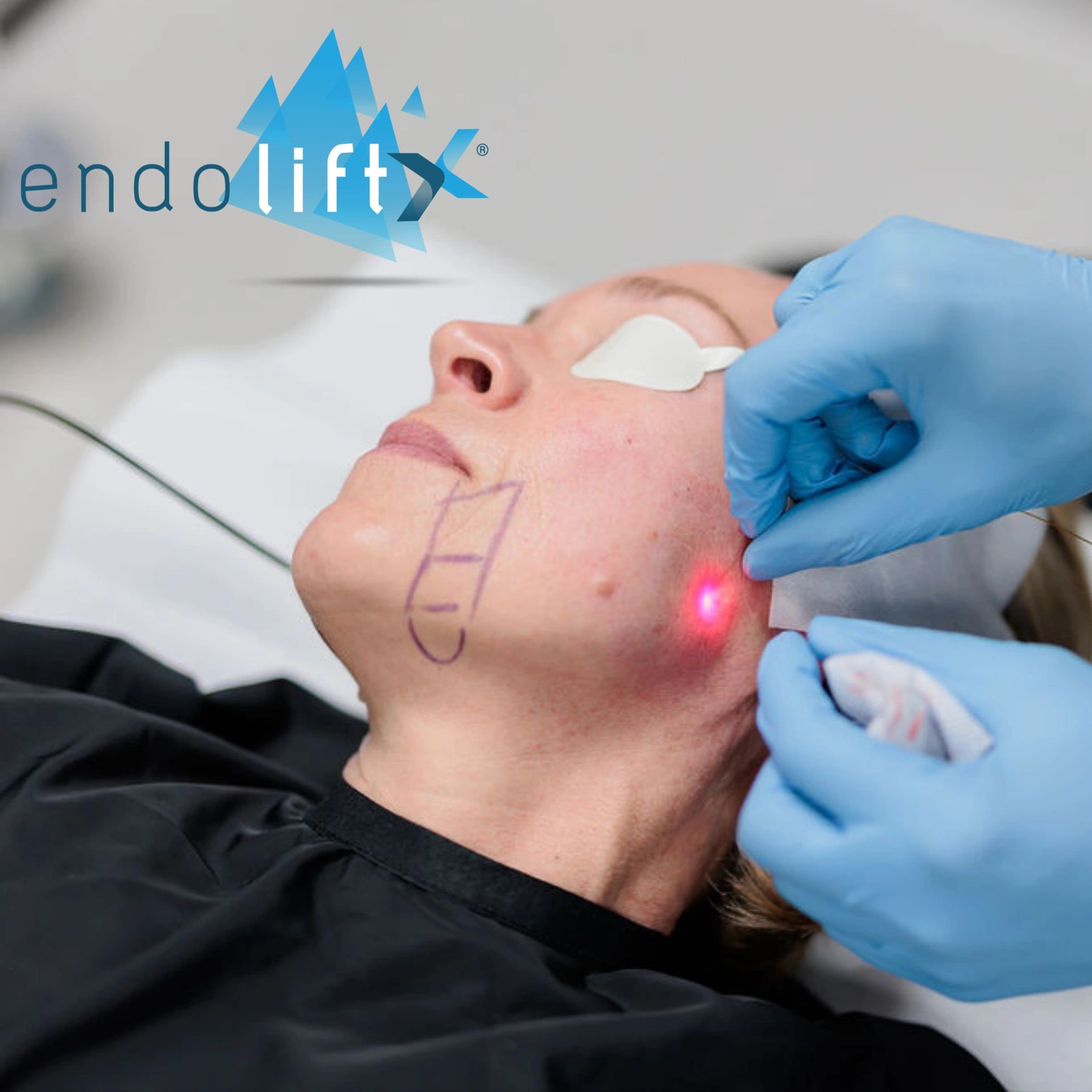 Endolift Laser
