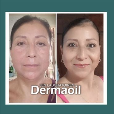 Llevo 6 semanas usando la crema y mi piel empezó a emparejarse, estoy feliz con los resultados.