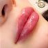 Lips after lip filler injections