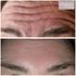 Botox forehead before and after