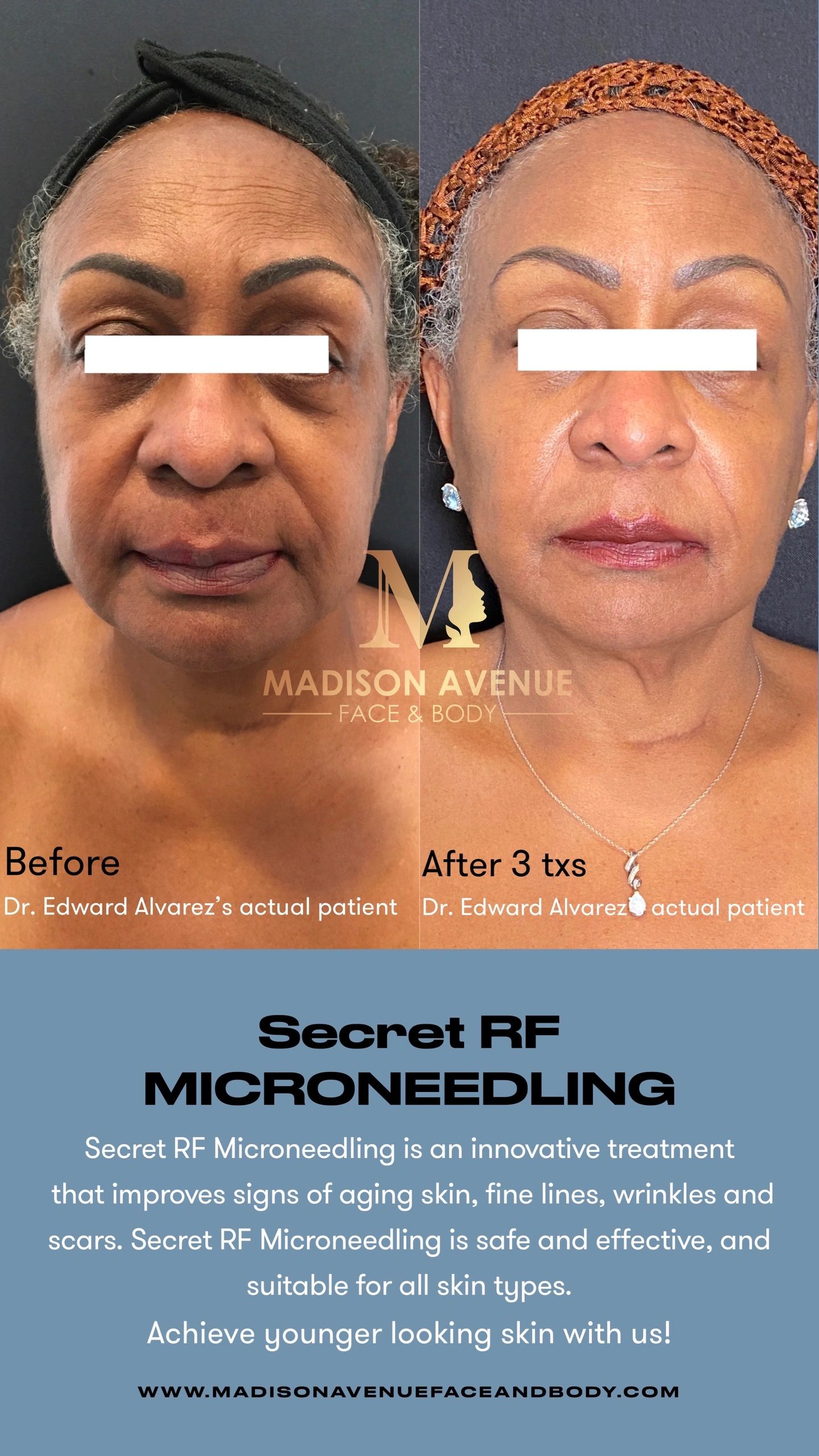 Secret RF results non-surgical face lift done by Dr. Edward Alvarez Madison Avenue Face and Body nyc