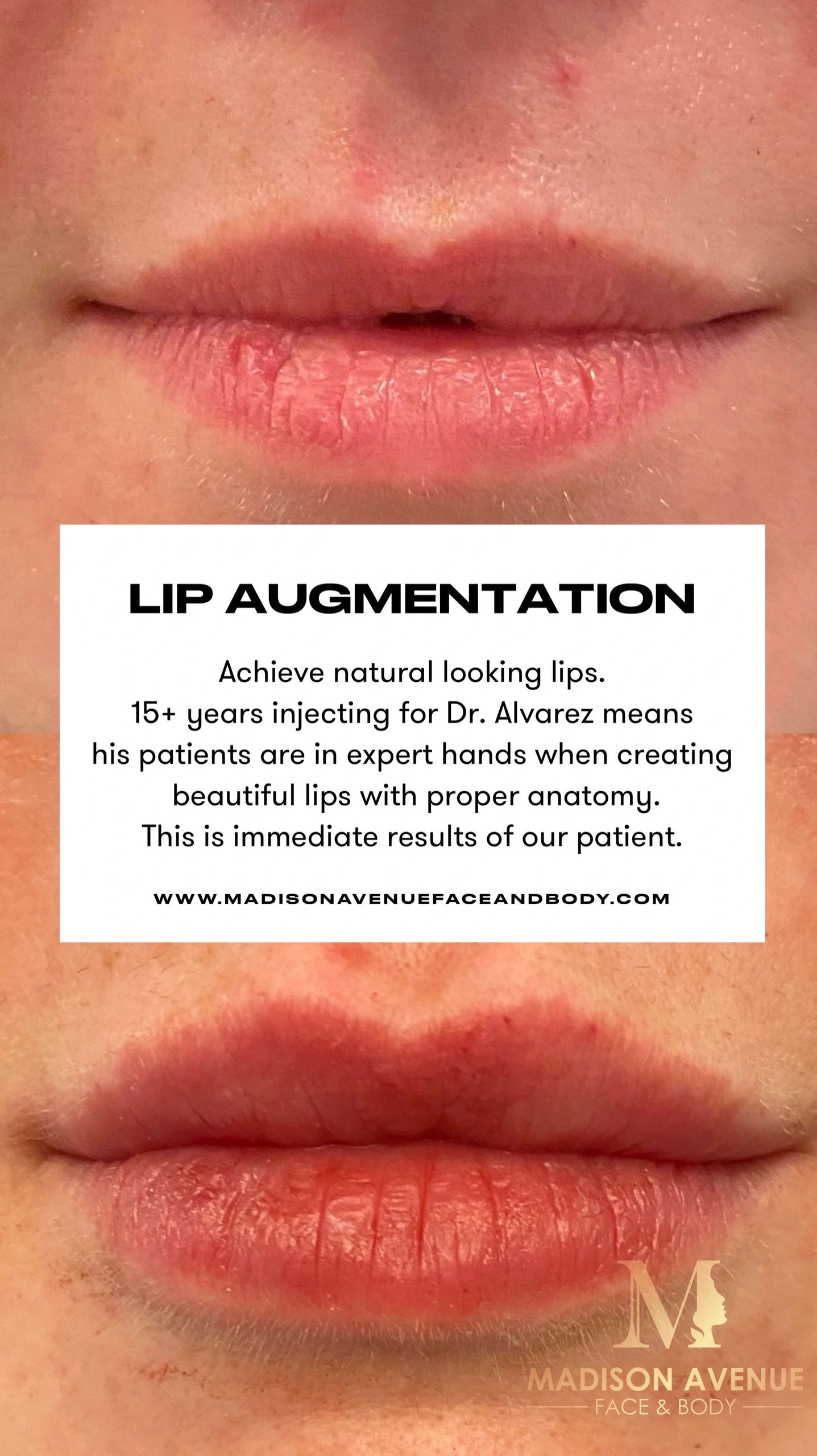 Lip Filler lip augmentation by Dr. Edward Alvarez Madison Avenue Face and Body NYC and Miami