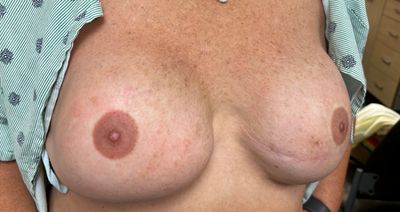 Image showing female breasts with visible bruising and swelling.