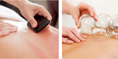 Gua-Sha and Cupping St Petersburg Tampa Clearwater Acupuncture Healing