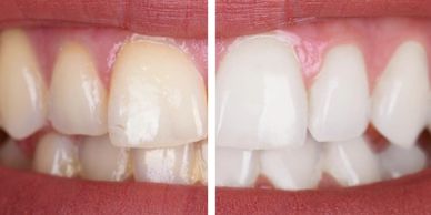 Teeth whitening, zoom whitening at North Star Dentistry in Mississauga.