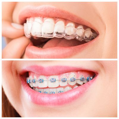 Braces or Invisalign? We have them all.