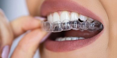Clear Aligners, Invisalign, orthodontist at North Star Dentistry in Mississauga.