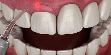 Laser gum lift, laser gum surgery, no pain at North Star Dentistry in Mississauga.