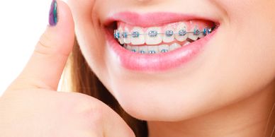 Braces, ortho braces, invisalign, clear aligners,  crooked teeth alignment in Mississauga