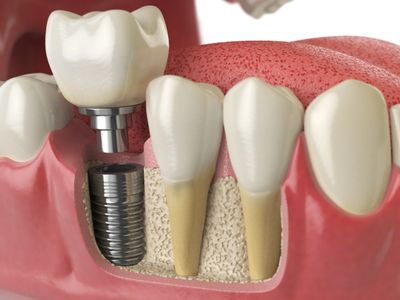 Dental Implants - Book your consult now!