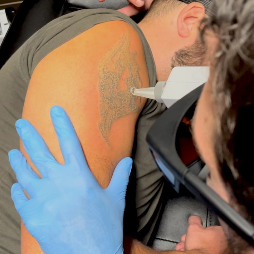 Laser specialist performing advanced aesthetic treatment at Tones Laser Removal in Hythe Southampton