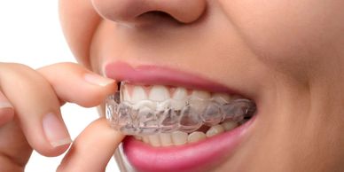 Invisalign. Sistema de tratamento ortodôntico sem uso de braquetes ou aparelho fixo. Também conhecido como alinhadores ortodônticos.