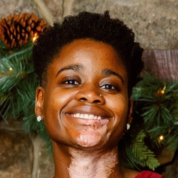 Smiling woman with natural hair and vitiligo in festive setting.