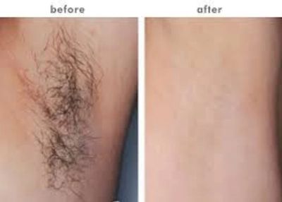 Axillae before and after 3 IPL hair removal sessions, Underarm permanent hair removal, underarm hair