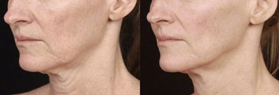 Skin tightening, loose skin, double chin, radiofrequency, PEMF, Body contouring, body sculpting