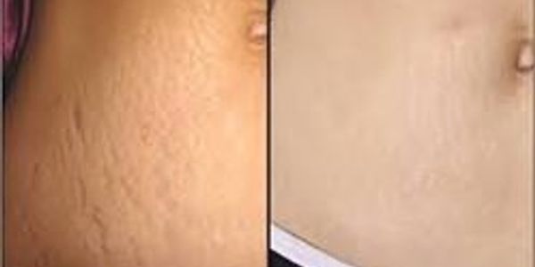 Stretchmarks, skin tightening, skin resurfacing, skin improvement