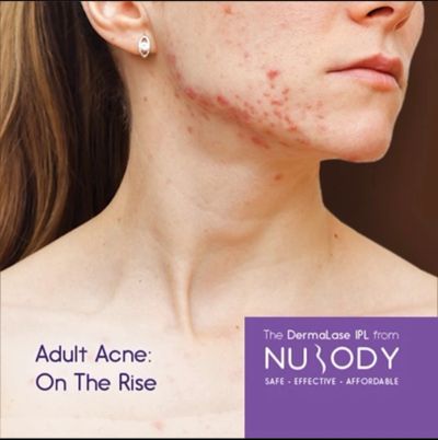 Adult Acne, Photofacial, IPL, Acne facial peel, NuBody Dermalase, LED light therapy, Active acne