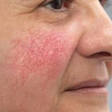 Rosacea, IPL, skin rejuvenation, red skin, red cheeks