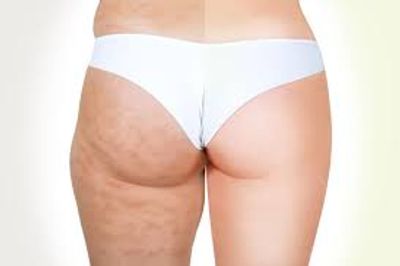 Cellulite treatment, Radio Frequency, PEMF, RF, Skin tightening, Cellulite reduction, Skin smoothing