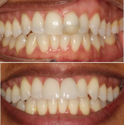 Beautiful smiles created with Invisalign and porcelain veneers