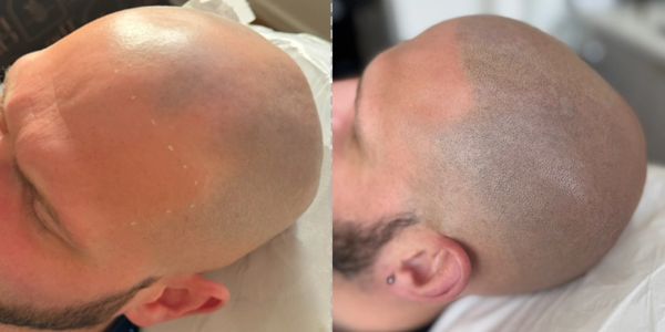 Scalp micro pigmentation hairline