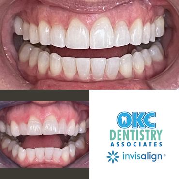 Invisalign OKC - Invisalign and Clear Braces Treatment Oklahoma