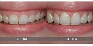 gum contouring, gingival contouring, gummy smile, laser dentist