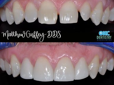 before and after of cosmetic porcelain dental veneers