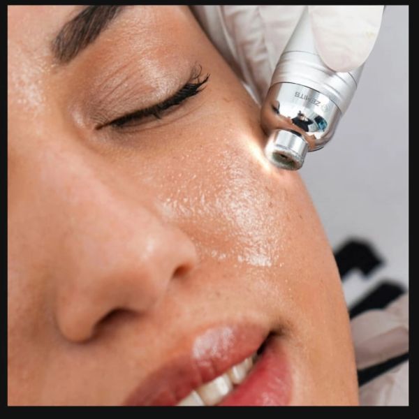 Close-up of facial skin treatment with a handheld device.