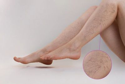 Aplicação de varizes em Itaboraí Clínica Modele