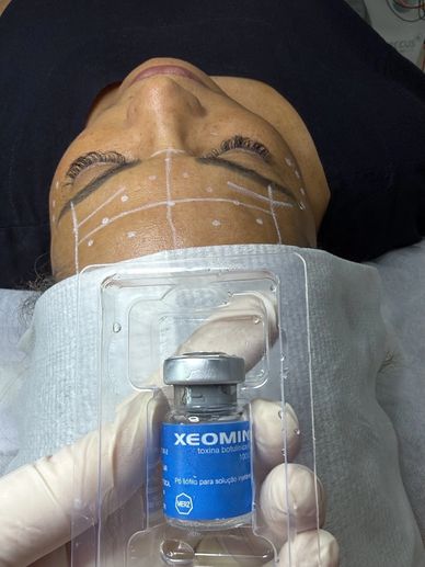 Toxina botulínica aplicação em clinica Modèle Itaboraí rio de janeiro