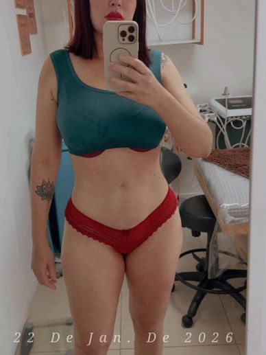 Abdômen sequinho após criolipólise em clinica modèle Itaboraí 