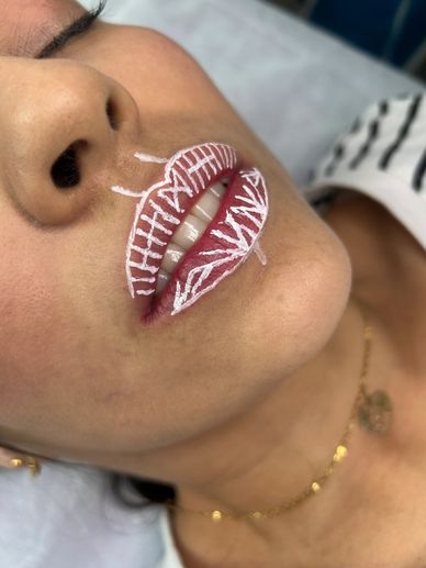 Técnica russa de preenchimento labial em clinica modèle itaborai