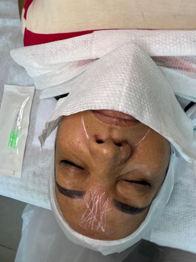 Preparaçao da face para aplicação de fios de PDO polidioxanona monofilamento em clinica modèle Itabo