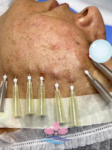 Fios de PDO polidioxanona aplicação em clinica Modèle  Itaboraí rj