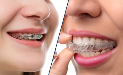 BRACES (left) vs INVISALIGN (right)