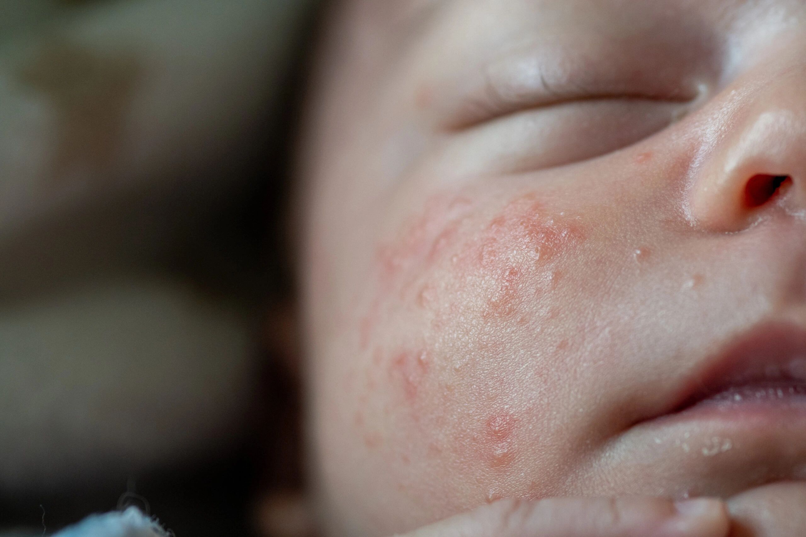 Common Baby Rashes Explained: What’s Normal and When to Act