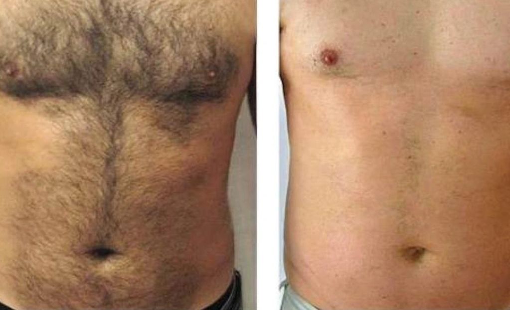Chest results after 6 Sessions.