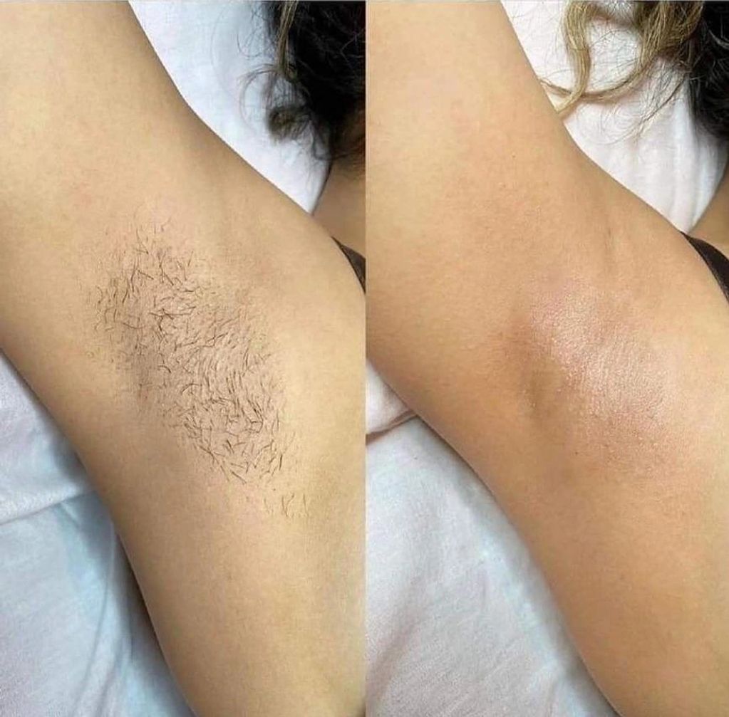 Underarms results after 6 Sessions