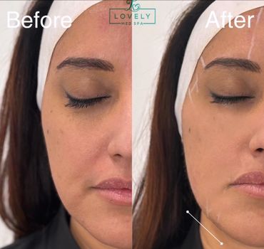 Tighten Loose Skin on Jowls