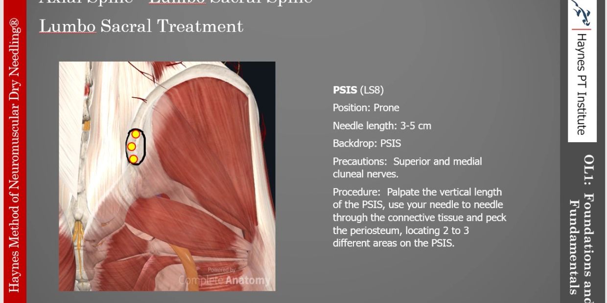 Dry needling technique on PSIS in prone position.