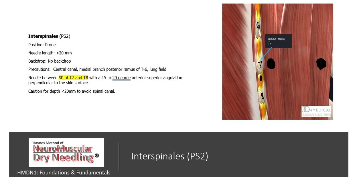 Diagram for interspinales dry needling targeting T7 and T8 spinous processes.