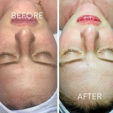 Before and after facial skin treatment showing clearer skin.