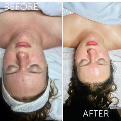 Before and after skin treatment showing clearer complexion.