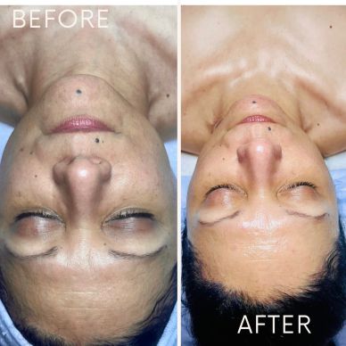Before and after facial treatment comparison.