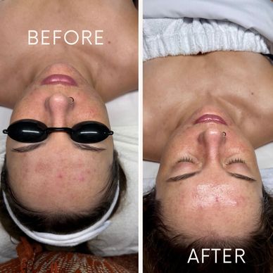 Before and after skin treatment showing clearer skin.