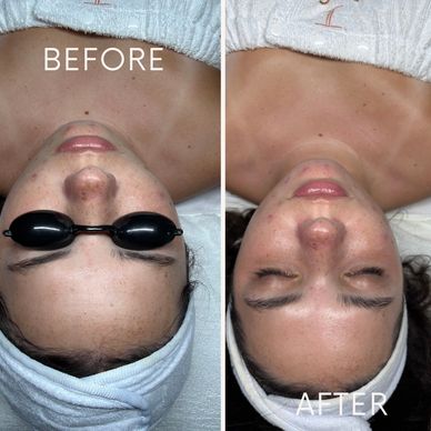 Before and after facial treatment showing clearer skin.