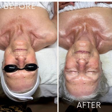 Before and after skin treatment on an elderly woman.